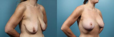 Breast Lift Before & After Gallery - Patient 783435 - Image 2