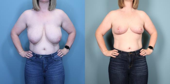 Breast Lift Before & After Gallery - Patient 307152 - Image 1