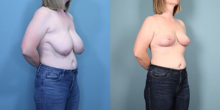 Breast Lift Before & After Gallery - Patient 307152 - Image 2