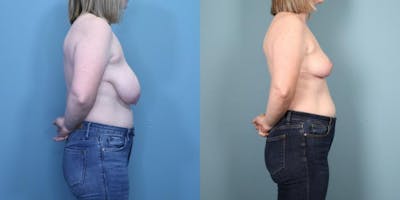 Breast Lift Before & After Gallery - Patient 307152 - Image 3