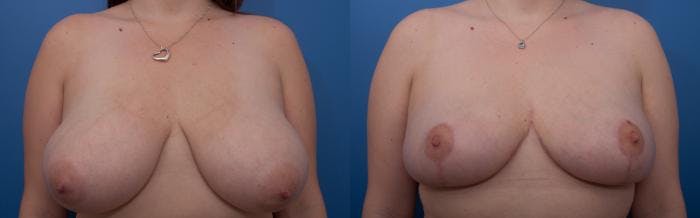 Breast Reduction Before & After Gallery - Patient 206242 - Image 1