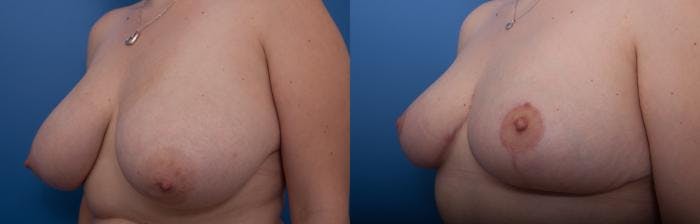 Breast Reduction Before & After Gallery - Patient 206242 - Image 2