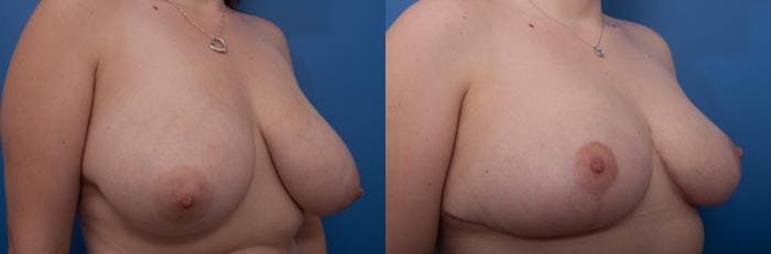 Breast Reduction Before & After Gallery - Patient 206242 - Image 3
