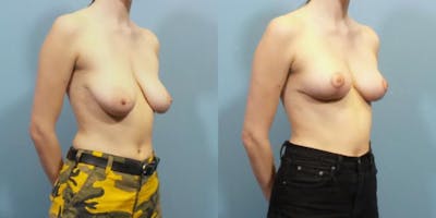 Breast Reduction Before & After Gallery - Patient 156059 - Image 2