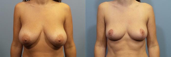 Breast Reduction Before & After Gallery - Patient 257137 - Image 1