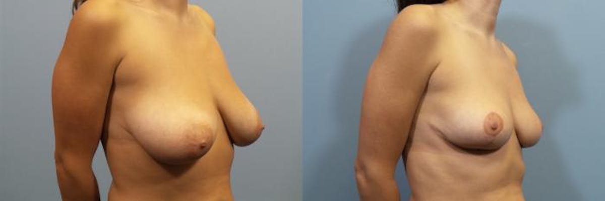 Breast Reduction Before & After Gallery - Patient 257137 - Image 2