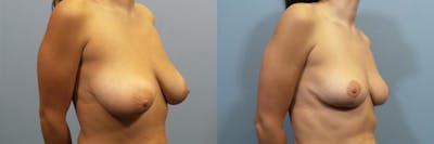 Breast Reduction Before & After Gallery - Patient 257137 - Image 2