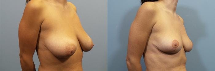 Breast Reduction Before & After Gallery - Patient 257137 - Image 2