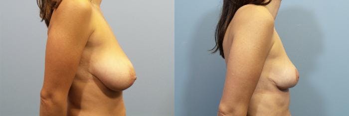 Breast Reduction Before & After Gallery - Patient 257137 - Image 3