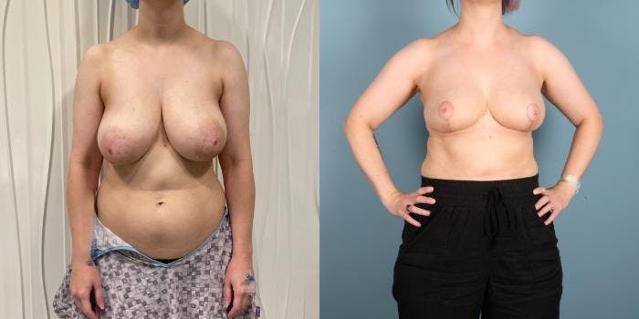 Breast Reduction Before & After Gallery - Patient 977015 - Image 1