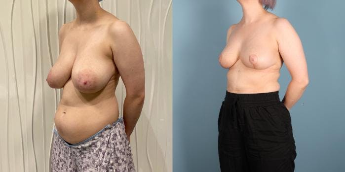 Breast Reduction Before & After Gallery - Patient 977015 - Image 2
