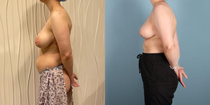 Breast Reduction Before & After Gallery - Patient 977015 - Image 3