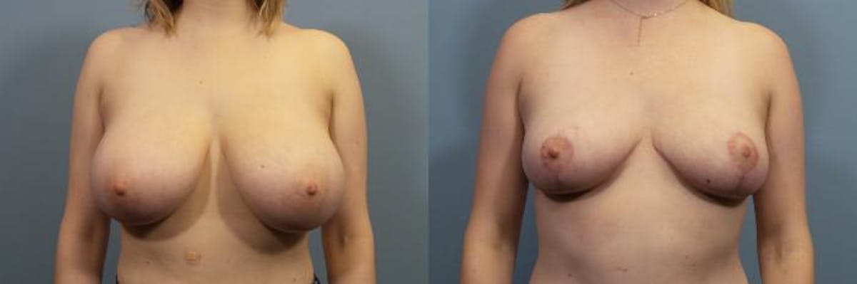 Breast Reduction Before & After Gallery - Patient 181216 - Image 1