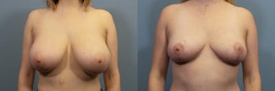 Breast Reduction Before & After Gallery - Patient 181216 - Image 1