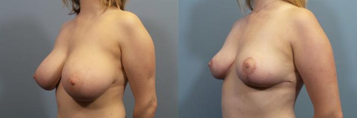 Breast Reduction Before & After Gallery - Patient 181216 - Image 2
