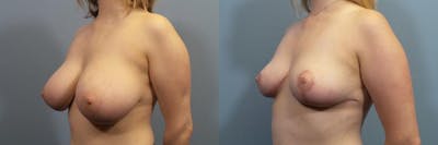 Breast Reduction Before & After Gallery - Patient 181216 - Image 2