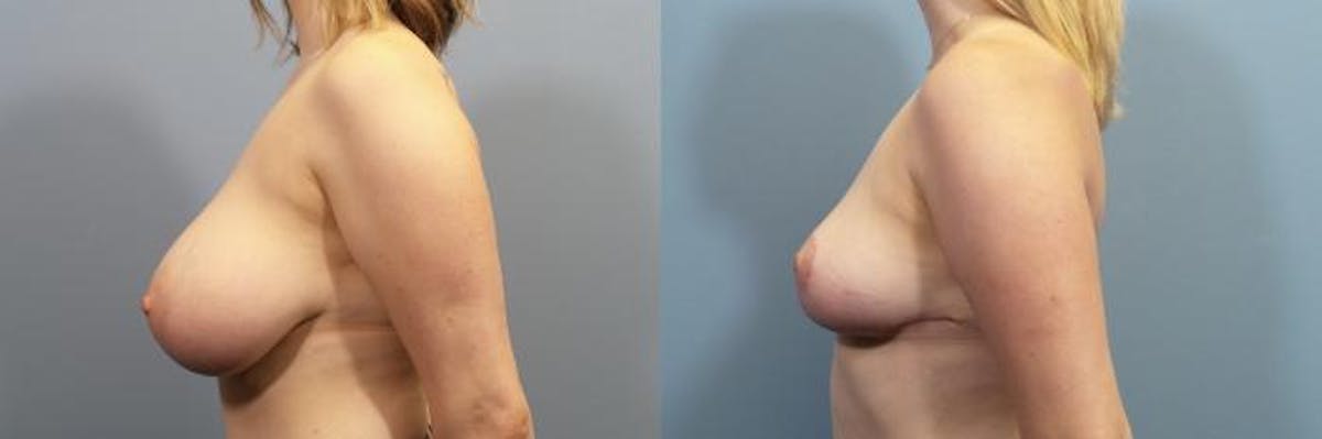 Breast Reduction Before & After Gallery - Patient 181216 - Image 3
