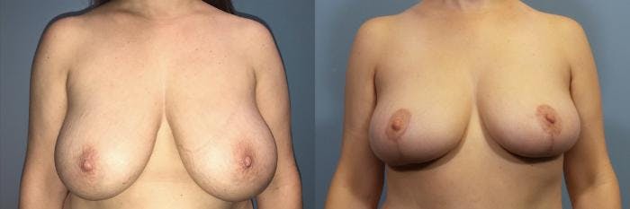 Breast Reduction Before & After Gallery - Patient 379749 - Image 1