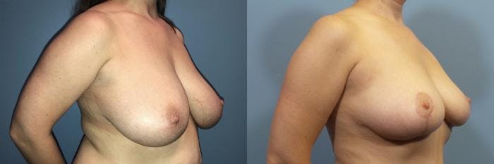 Breast Reduction Before & After Gallery - Patient 379749 - Image 2