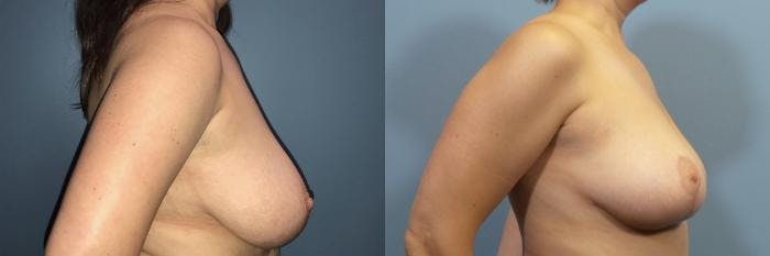 Breast Reduction Before & After Gallery - Patient 379749 - Image 3