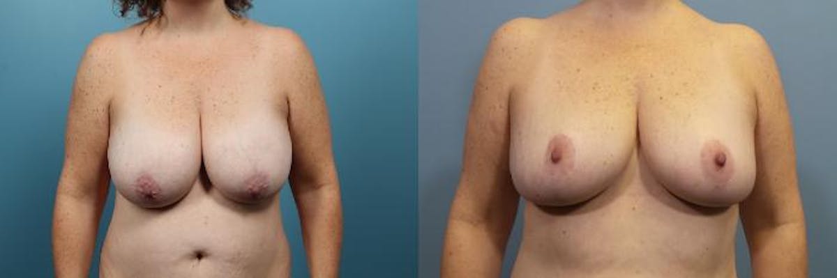 Breast Reduction Before & After Gallery - Patient 256626 - Image 1