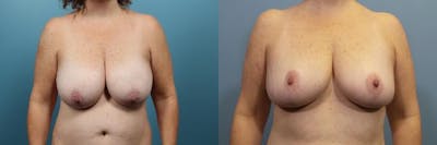 Breast Reduction Before & After Gallery - Patient 256626 - Image 1