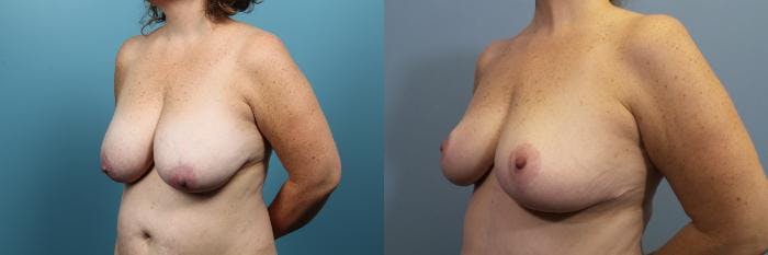 Breast Reduction Before & After Gallery - Patient 256626 - Image 2