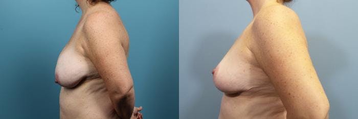 Breast Reduction Before & After Gallery - Patient 256626 - Image 3