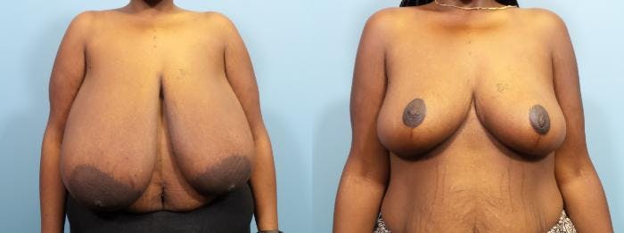 Breast Reduction Before & After Gallery - Patient 343057 - Image 1