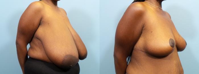 Breast Reduction Before & After Gallery - Patient 343057 - Image 2