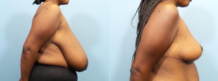 Breast Reduction Before & After Gallery - Patient 343057 - Image 3