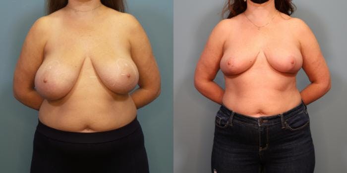 Breast Reduction Before & After Gallery - Patient 289514 - Image 1