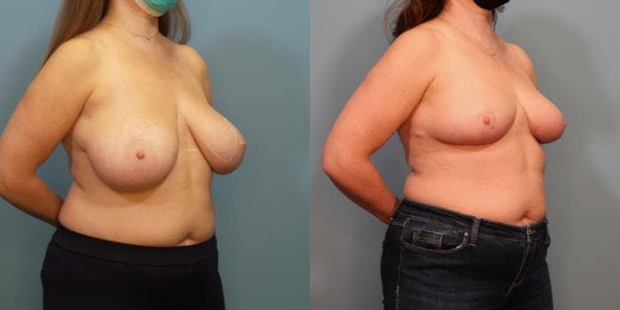Breast Reduction Before & After Gallery - Patient 289514 - Image 2