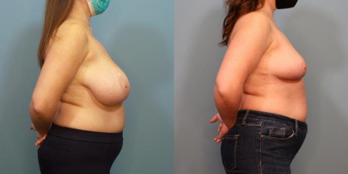 Breast Reduction Before & After Gallery - Patient 289514 - Image 3