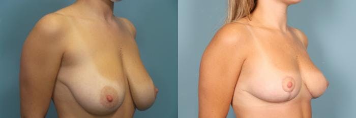 Breast Reduction Before & After Gallery - Patient 325415 - Image 2