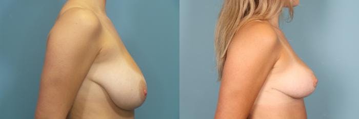 Breast Reduction Before & After Gallery - Patient 325415 - Image 3