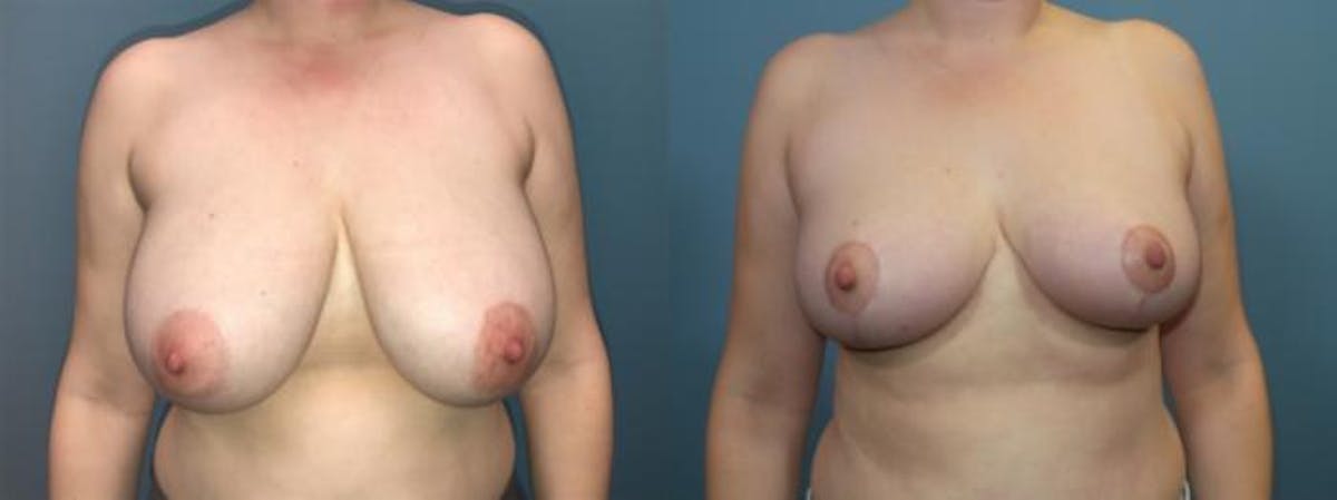 Breast Reduction Before & After Gallery - Patient 198323 - Image 1