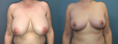Breast Reduction Before & After Gallery - Patient 198323 - Image 1
