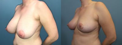 Breast Reduction Before & After Gallery - Patient 198323 - Image 2