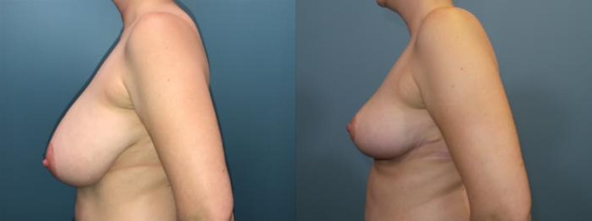 Breast Reduction Before & After Gallery - Patient 198323 - Image 3