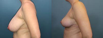 Breast Reduction Before & After Gallery - Patient 198323 - Image 3