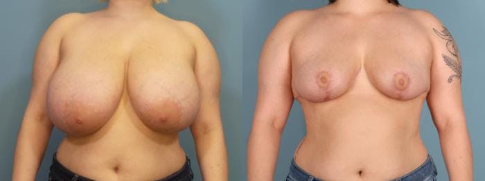 Breast Reduction Before & After Gallery - Patient 198112 - Image 1