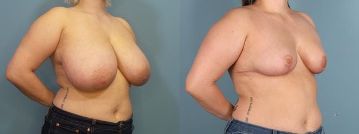 Breast Reduction Before & After Gallery - Patient 198112 - Image 2