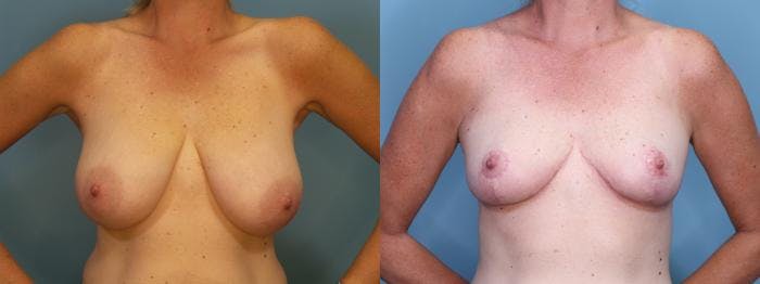 Breast Reduction Before & After Gallery - Patient 364237 - Image 1