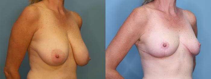 Breast Reduction Before & After Gallery - Patient 364237 - Image 2
