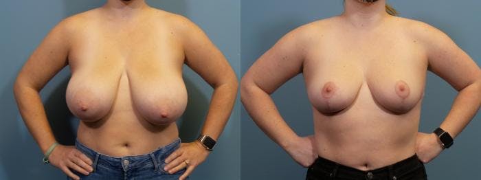 Breast Reduction Before & After Gallery - Patient 351930 - Image 1