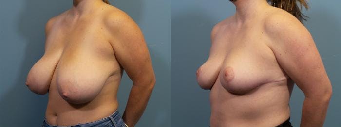 Breast Reduction Before & After Gallery - Patient 351930 - Image 2