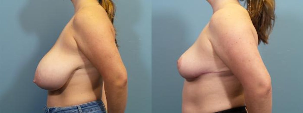 Breast Reduction Before & After Gallery - Patient 351930 - Image 3
