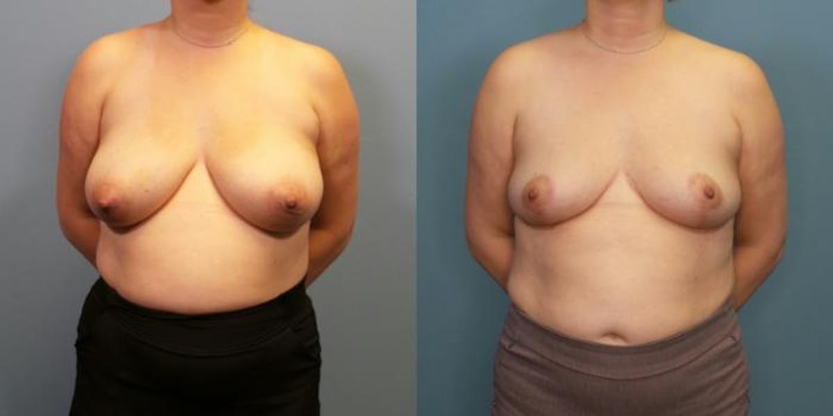 Breast Reduction Before & After Gallery - Patient 700265 - Image 1