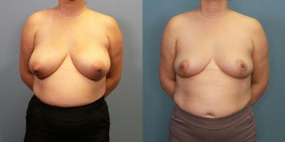 Breast Reduction Before & After Gallery - Patient 700265 - Image 1